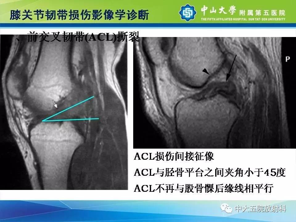 膝关节半月板和韧带损伤的影像学诊断