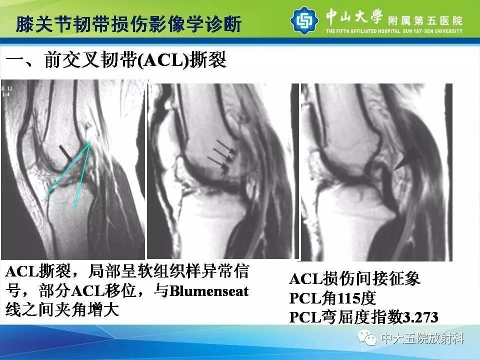 膝关节半月板和韧带损伤的影像学诊断