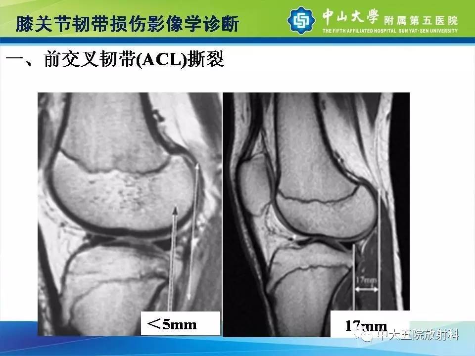 膝关节半月板和韧带损伤的影像学诊断