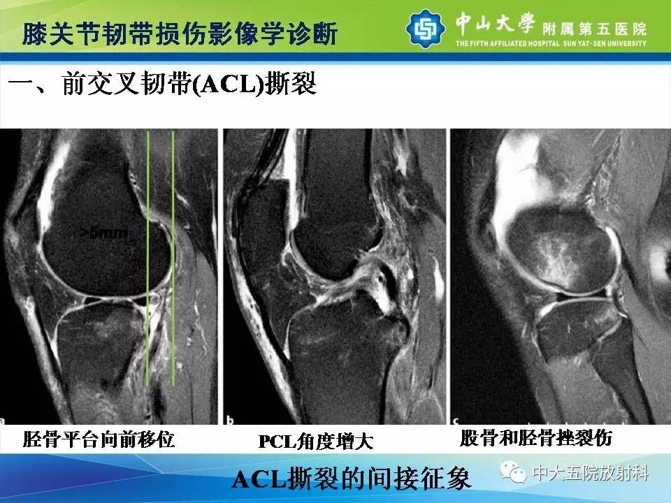 膝关节半月板和韧带损伤的影像学诊断