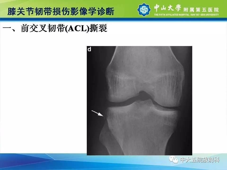 膝关节半月板和韧带损伤的影像学诊断