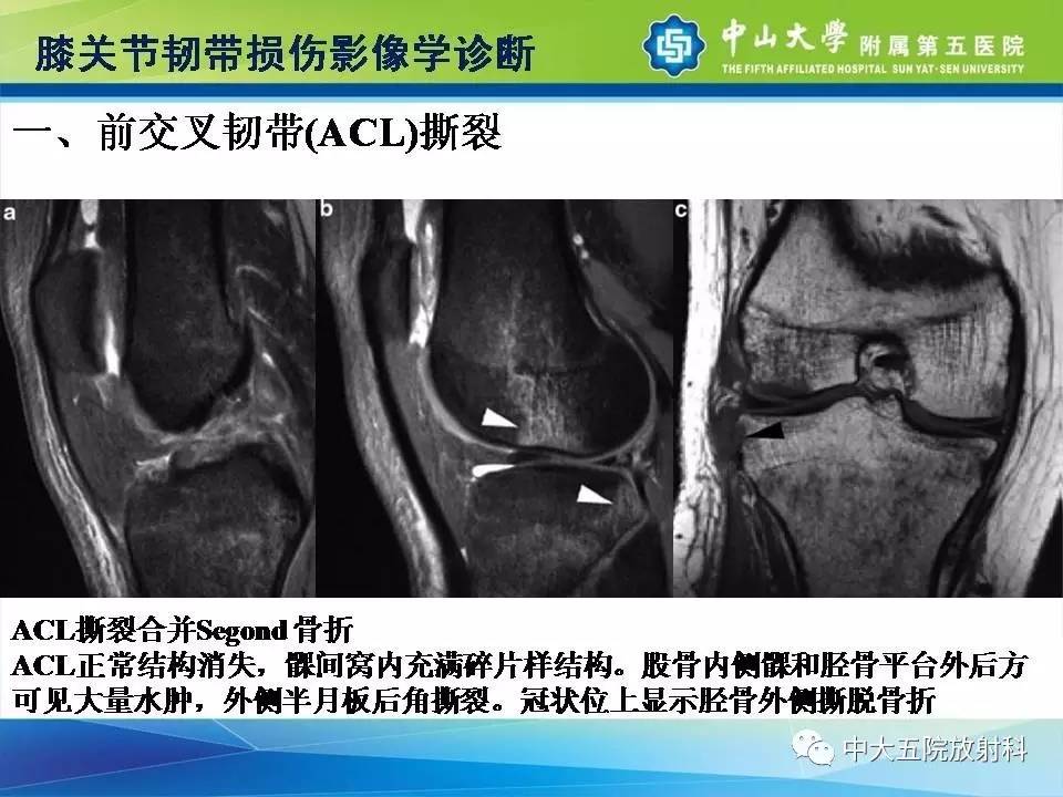 膝关节半月板和韧带损伤的影像学诊断