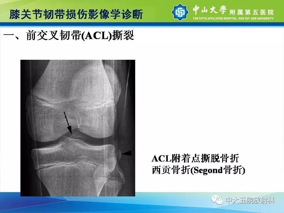 膝关节半月板和韧带损伤的影像学诊断