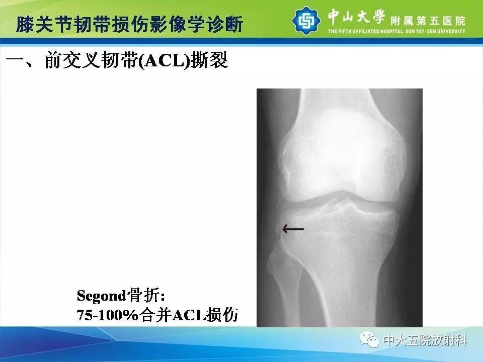 膝关节半月板和韧带损伤的影像学诊断