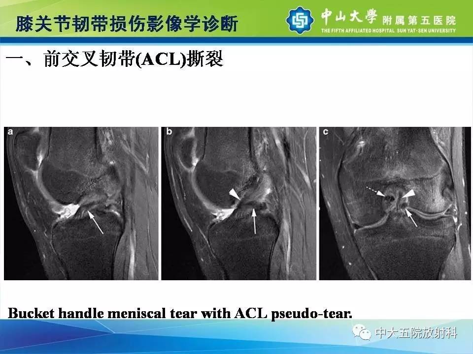 膝关节半月板和韧带损伤的影像学诊断