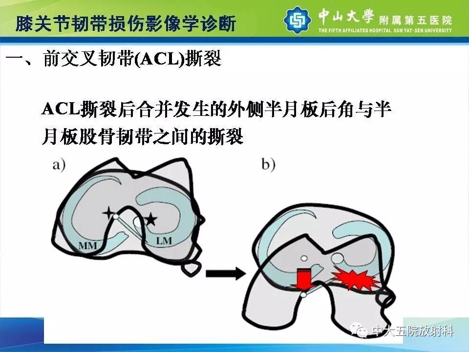 膝关节半月板和韧带损伤的影像学诊断