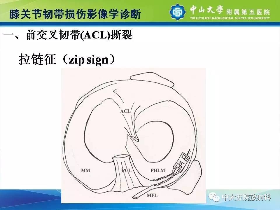 膝关节半月板和韧带损伤的影像学诊断