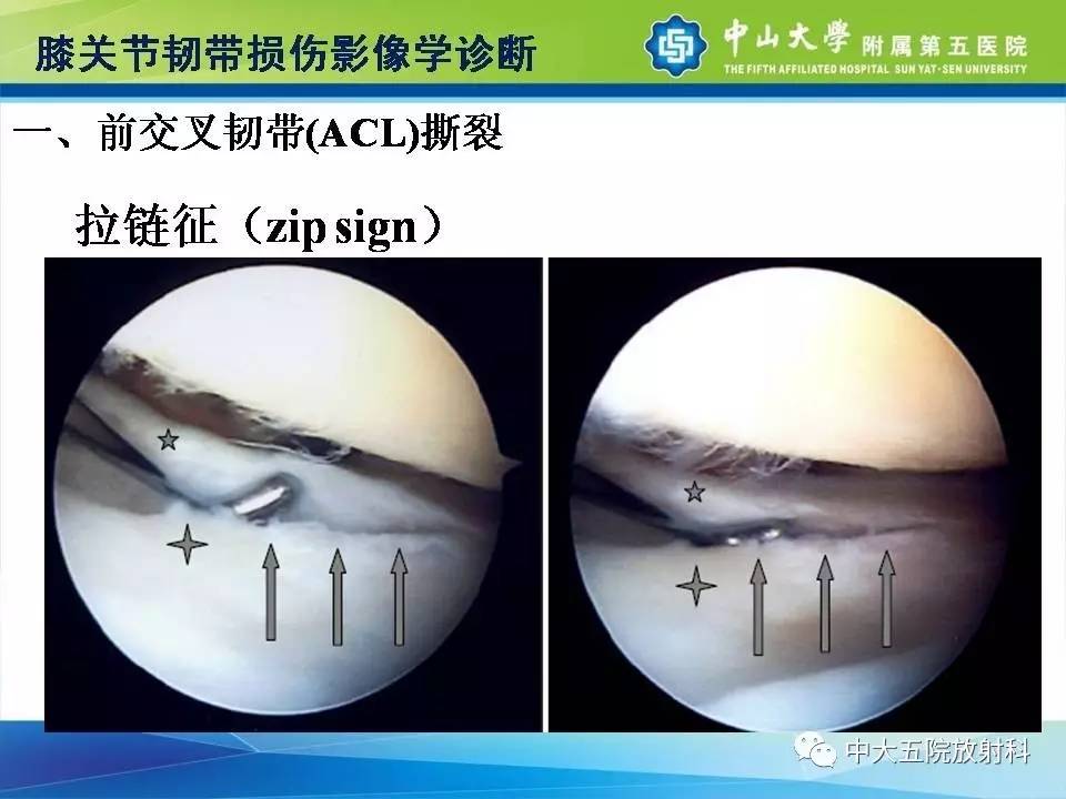 膝关节半月板和韧带损伤的影像学诊断