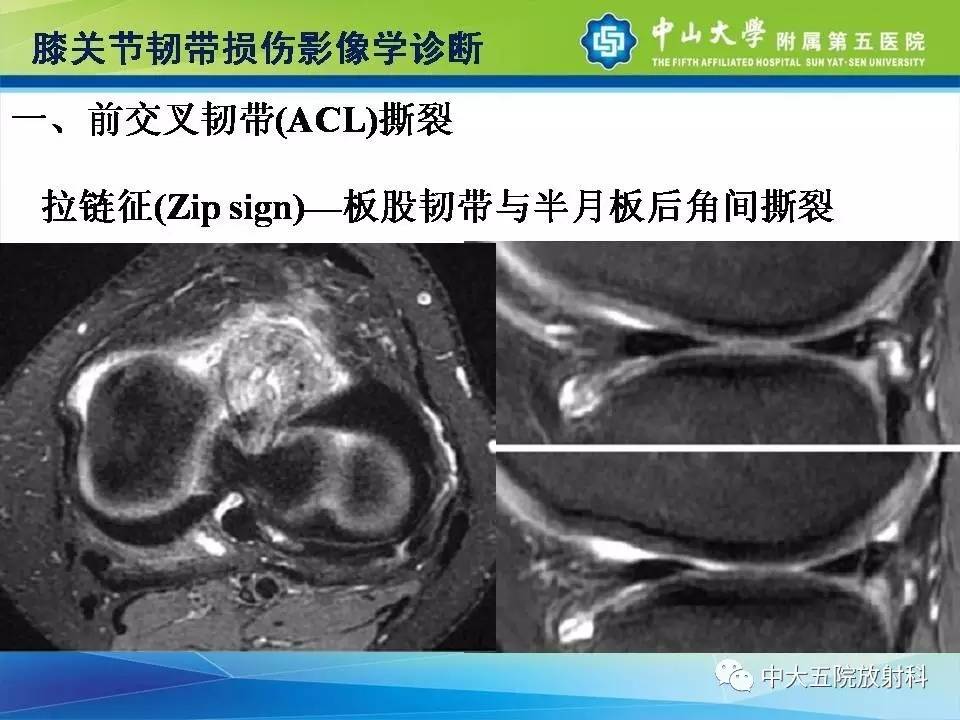 膝关节半月板和韧带损伤的影像学诊断