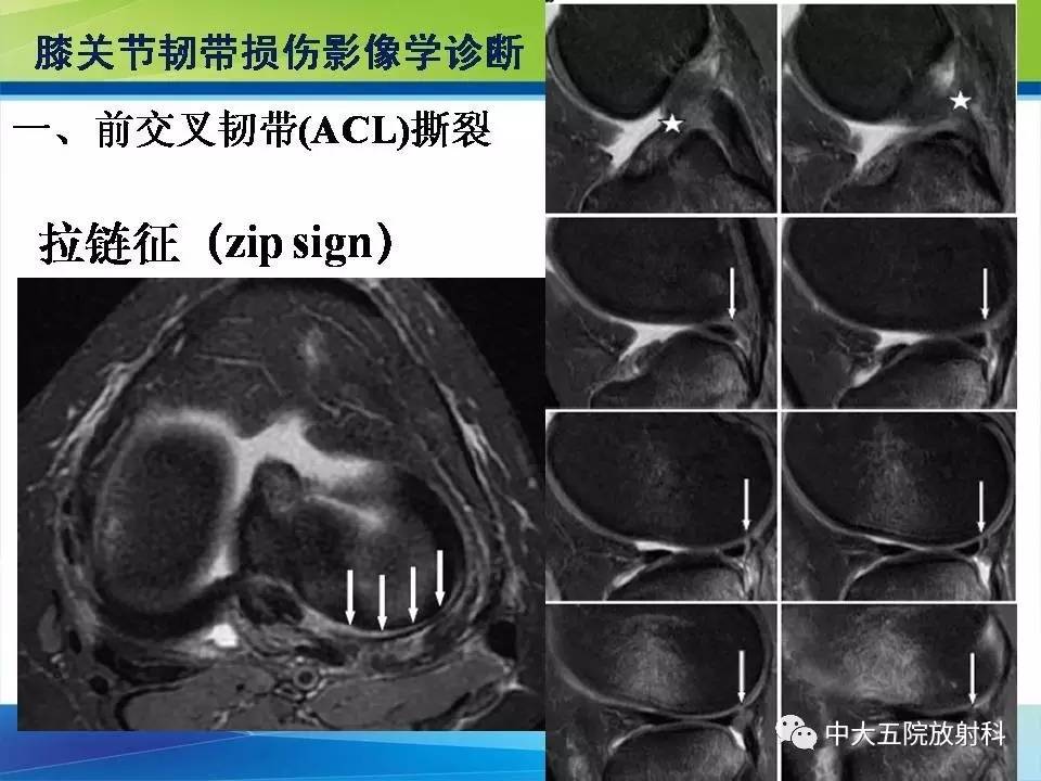 膝关节半月板和韧带损伤的影像学诊断