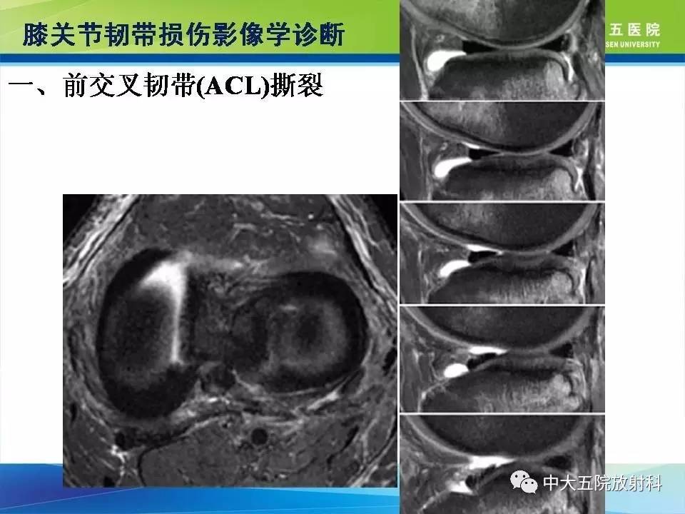 膝关节半月板和韧带损伤的影像学诊断