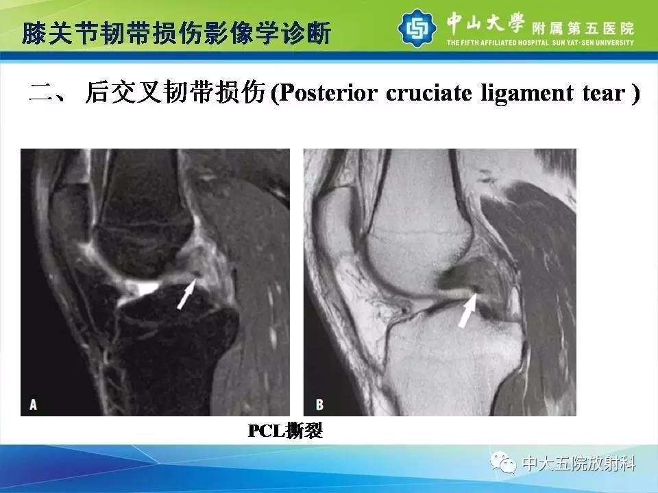 膝关节半月板和韧带损伤的影像学诊断