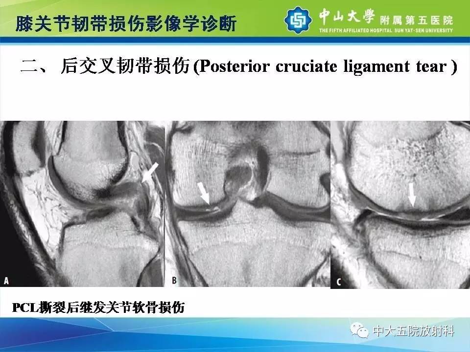 膝关节半月板和韧带损伤的影像学诊断