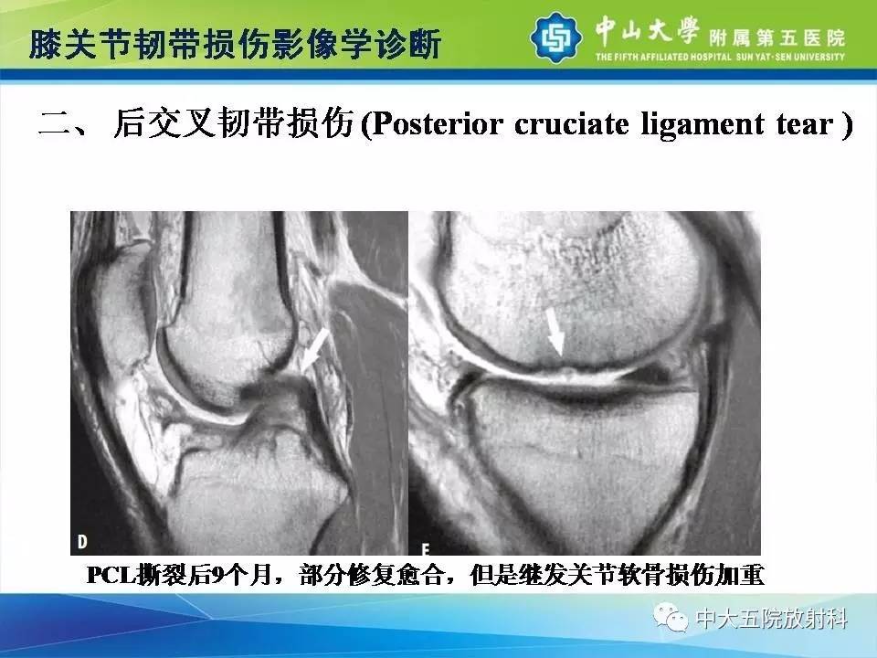 膝关节半月板和韧带损伤的影像学诊断