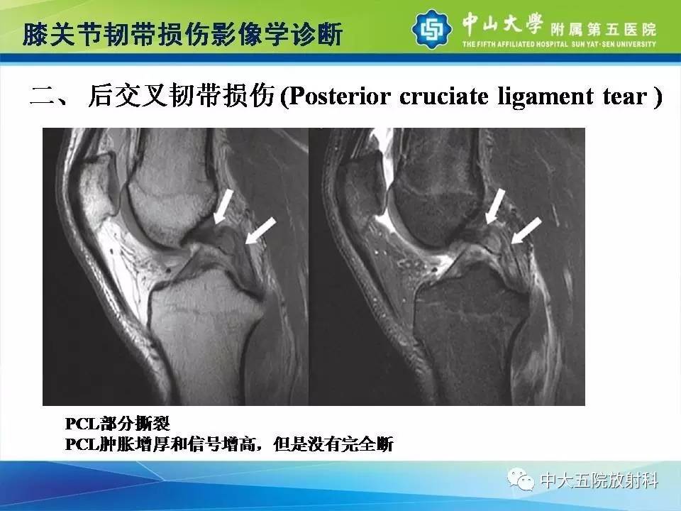 膝关节半月板和韧带损伤的影像学诊断