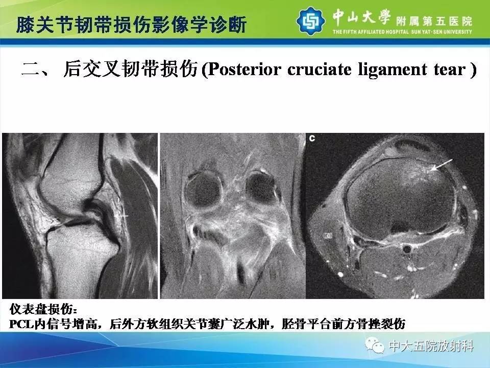 膝关节半月板和韧带损伤的影像学诊断