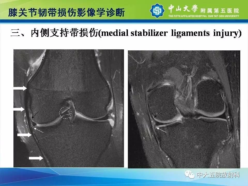 膝关节半月板和韧带损伤的影像学诊断