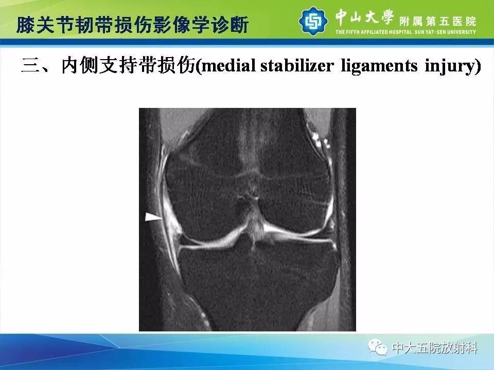 膝关节半月板和韧带损伤的影像学诊断