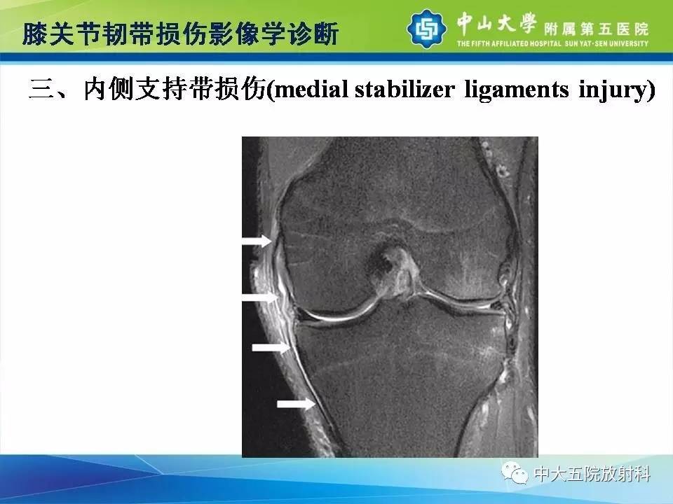 膝关节半月板和韧带损伤的影像学诊断