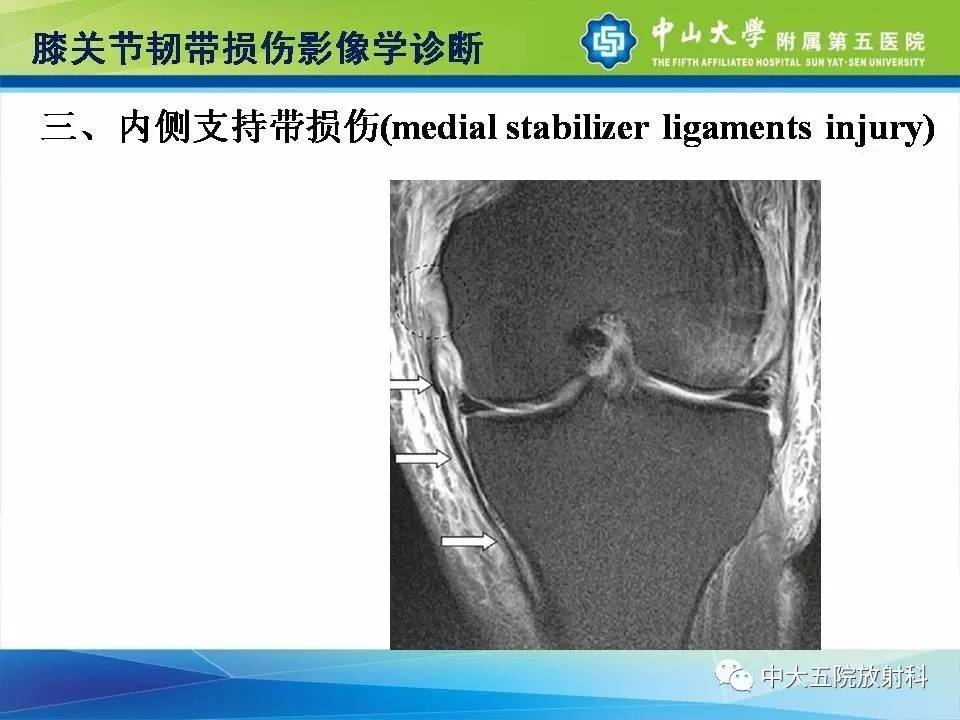 膝关节半月板和韧带损伤的影像学诊断