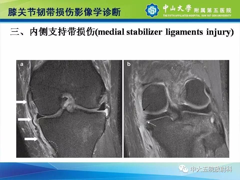 膝关节半月板和韧带损伤的影像学诊断