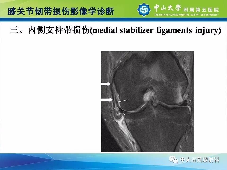 膝关节半月板和韧带损伤的影像学诊断