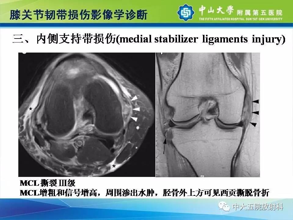 膝关节半月板和韧带损伤的影像学诊断