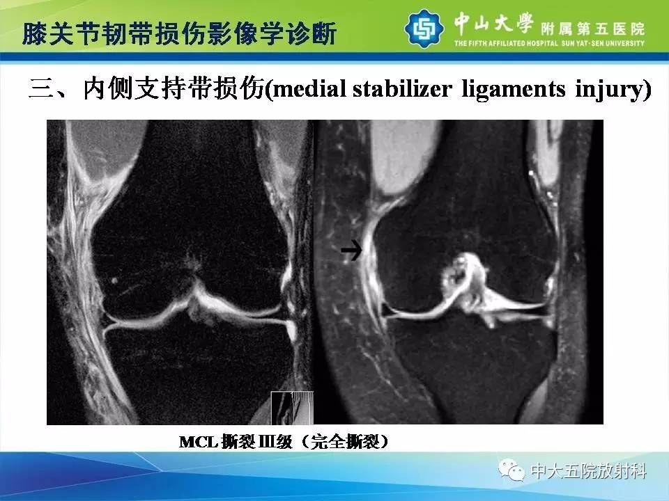 膝关节半月板和韧带损伤的影像学诊断