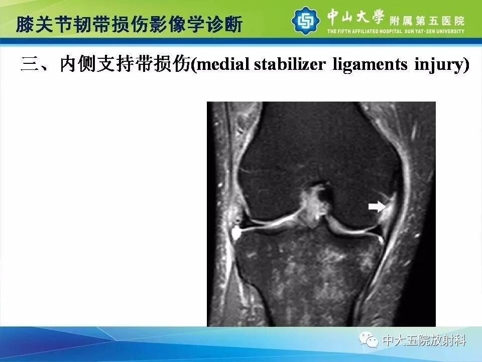 膝关节半月板和韧带损伤的影像学诊断