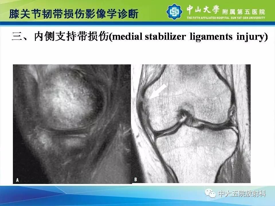 膝关节半月板和韧带损伤的影像学诊断