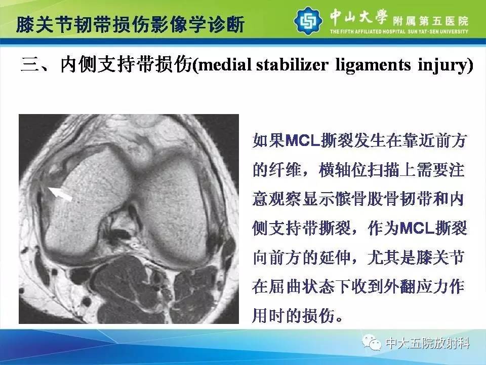 膝关节半月板和韧带损伤的影像学诊断