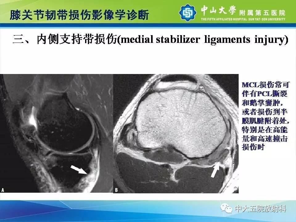 膝关节半月板和韧带损伤的影像学诊断