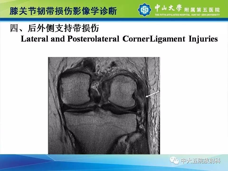 膝关节半月板和韧带损伤的影像学诊断