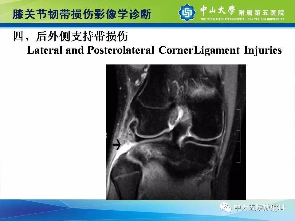 膝关节半月板和韧带损伤的影像学诊断