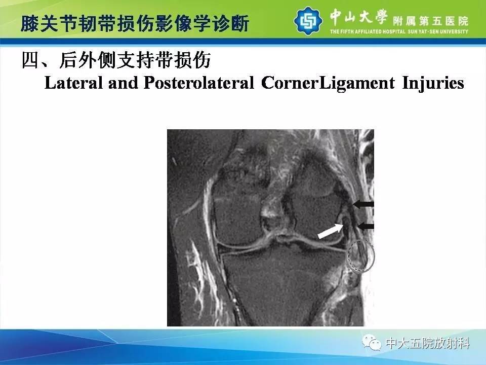 膝关节半月板和韧带损伤的影像学诊断