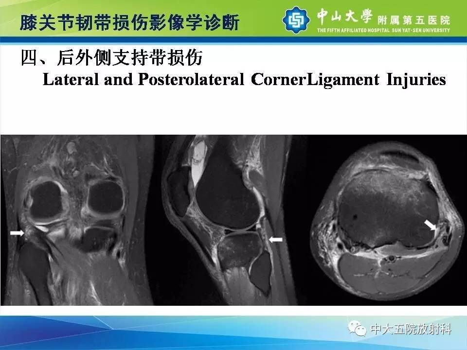 膝关节半月板和韧带损伤的影像学诊断