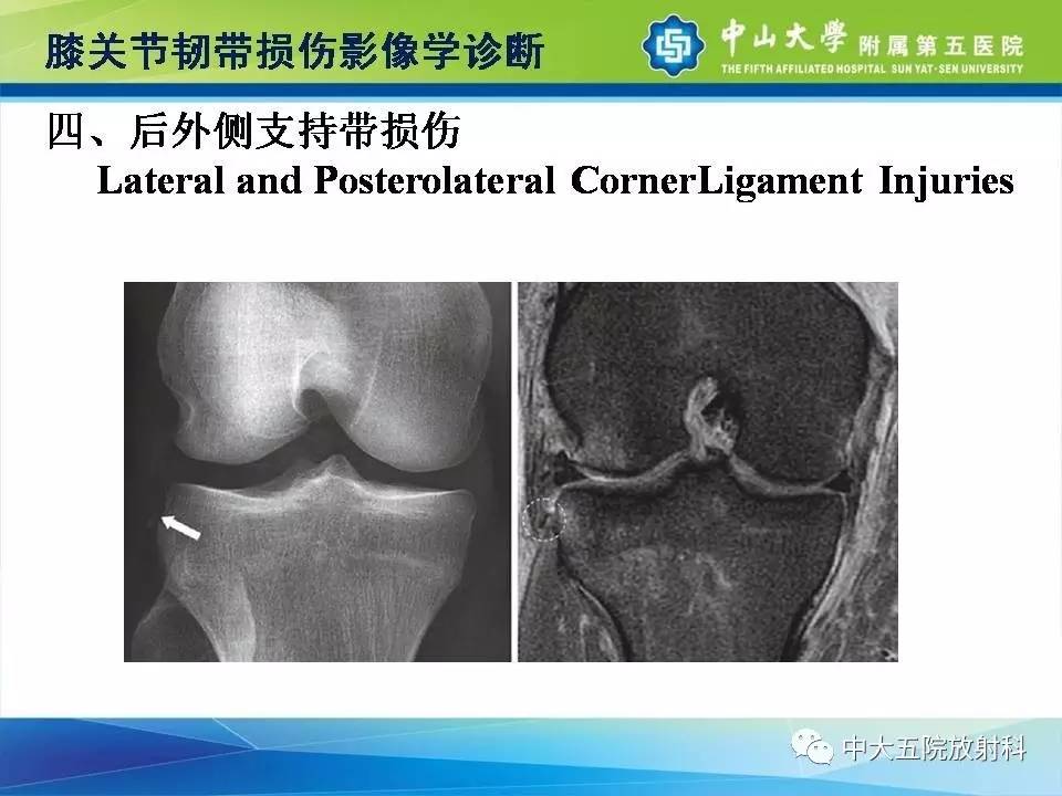 膝关节半月板和韧带损伤的影像学诊断