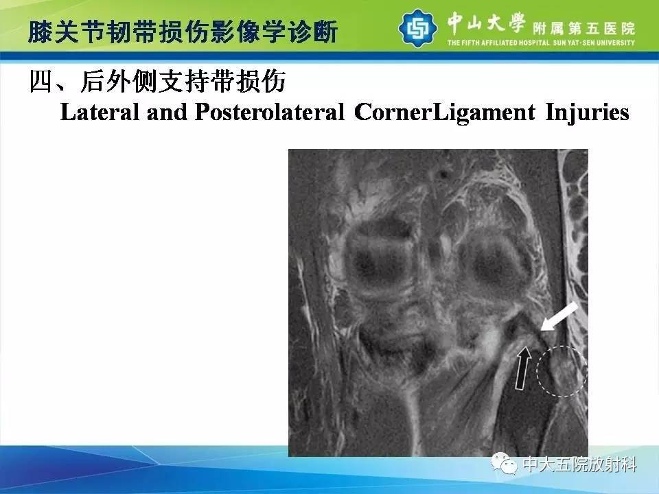 膝关节半月板和韧带损伤的影像学诊断