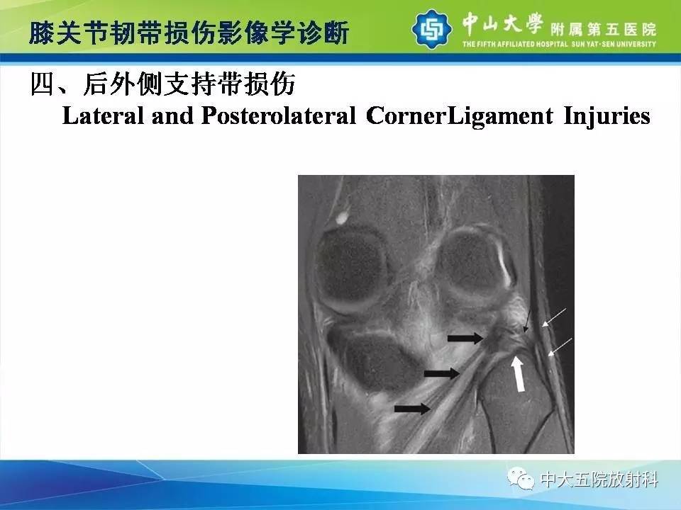 膝关节半月板和韧带损伤的影像学诊断