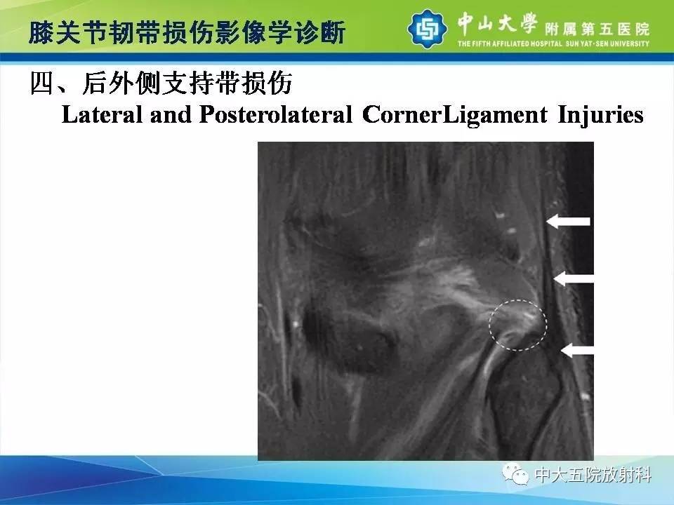 膝关节半月板和韧带损伤的影像学诊断