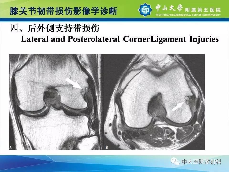 膝关节半月板和韧带损伤的影像学诊断