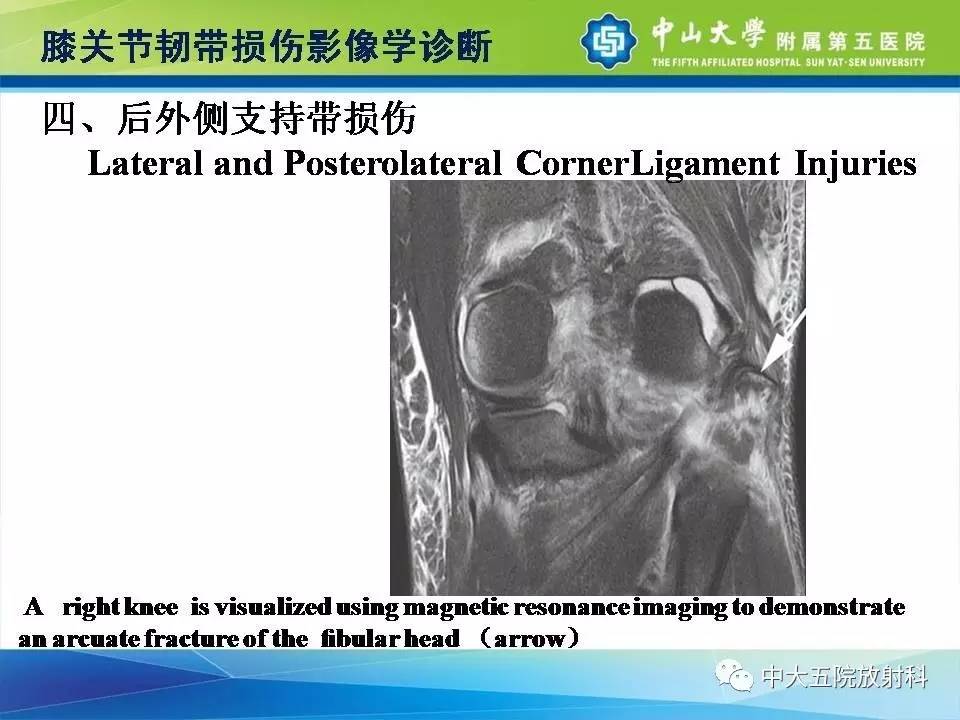 膝关节半月板和韧带损伤的影像学诊断