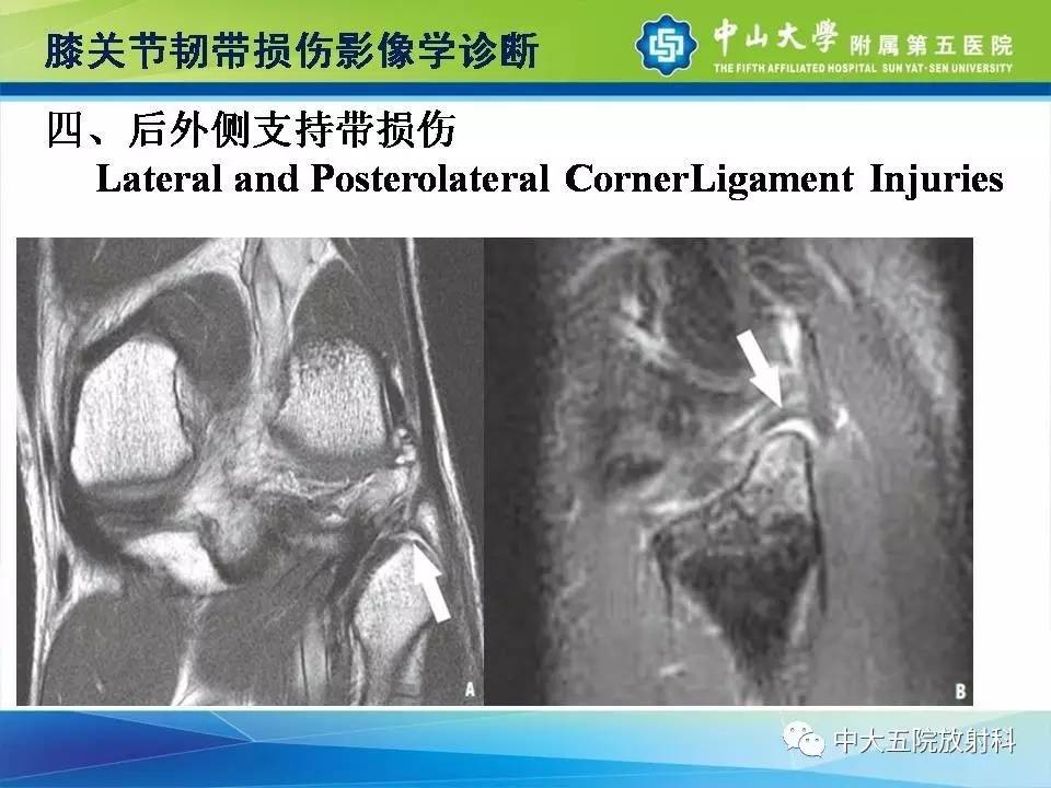 膝关节半月板和韧带损伤的影像学诊断