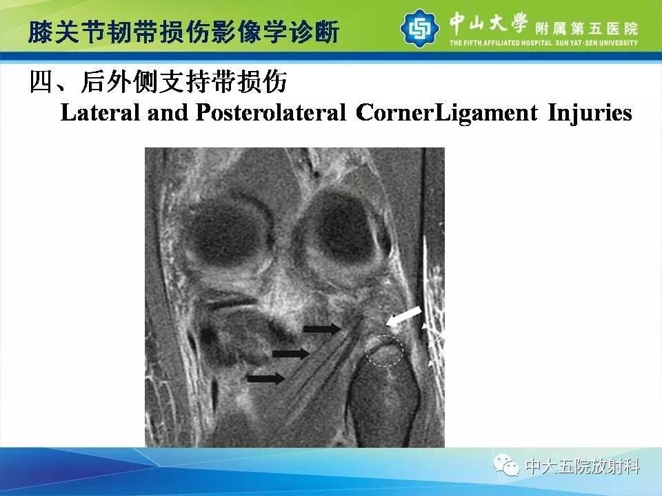 膝关节半月板和韧带损伤的影像学诊断