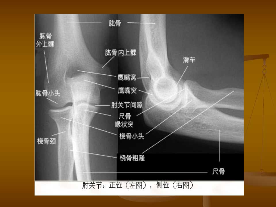 肘关节恐怖三联征的治疗原则