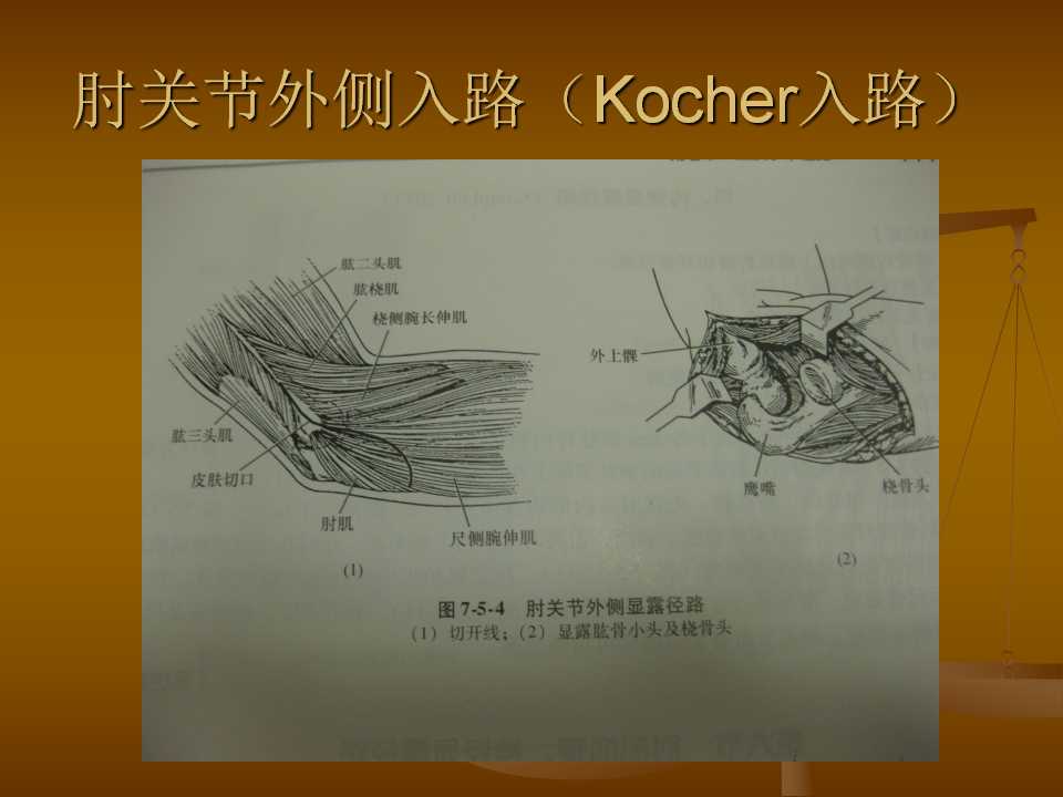 肘关节恐怖三联征的治疗原则