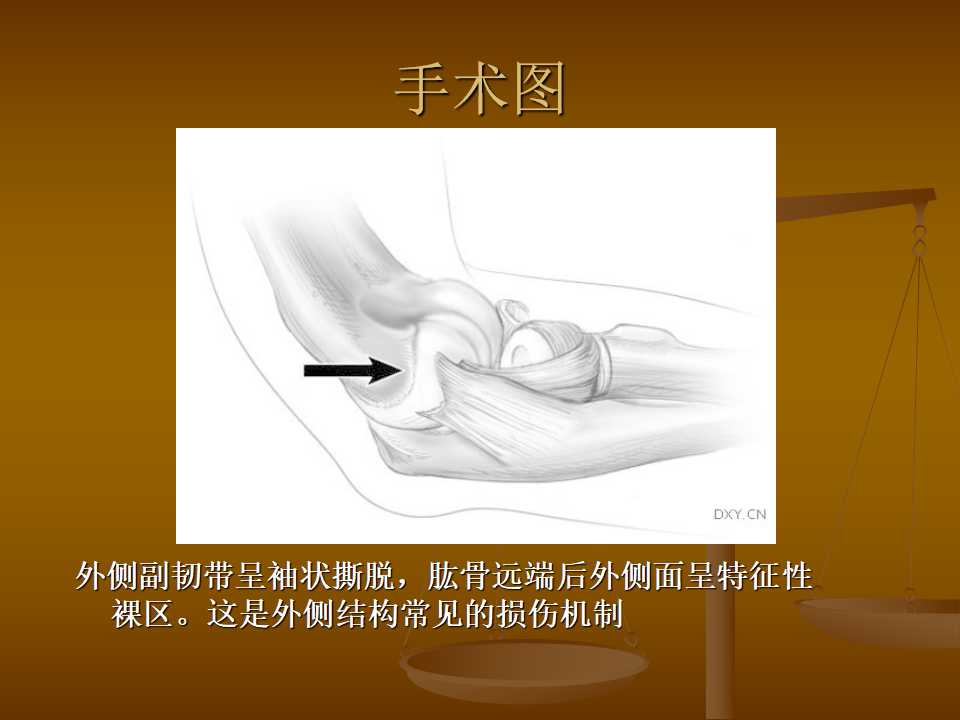 肘关节恐怖三联征的治疗原则