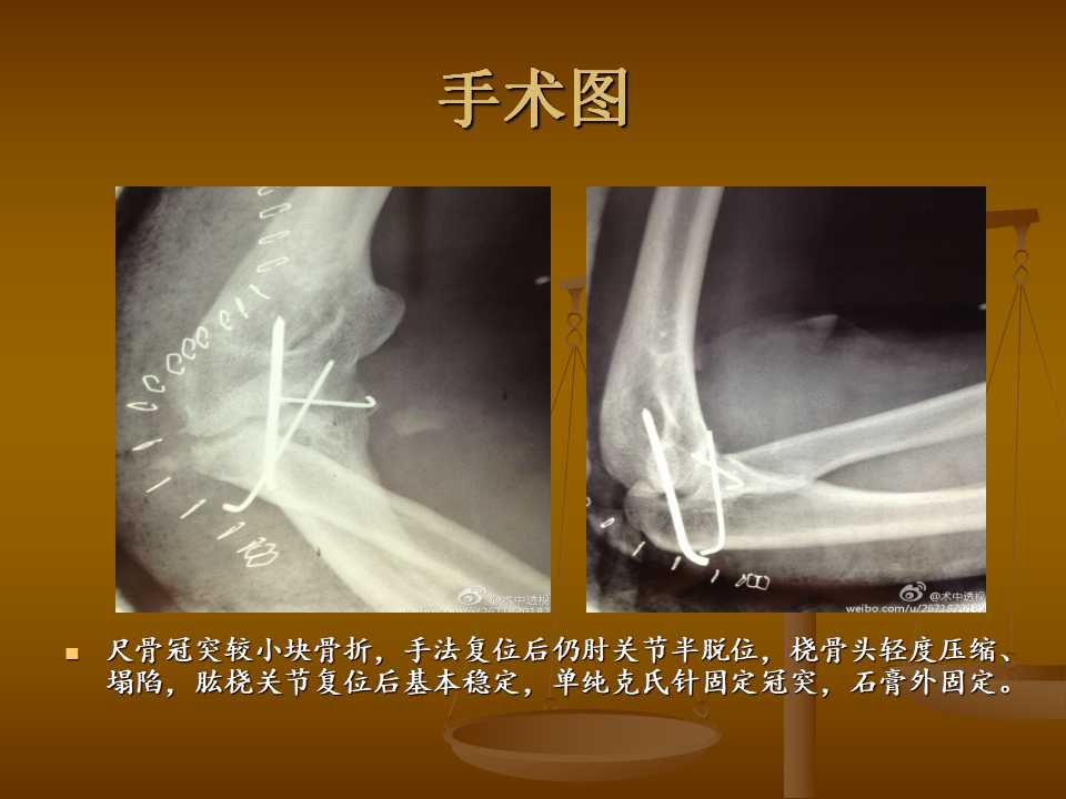 肘关节恐怖三联征的治疗原则