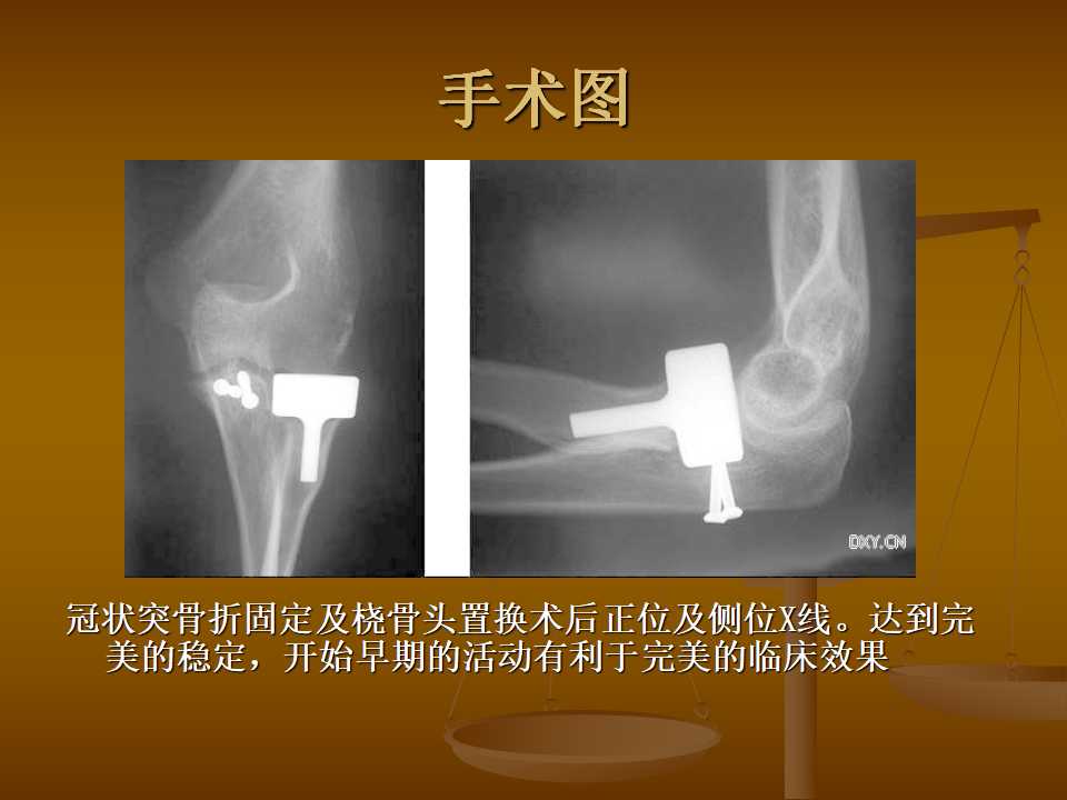 肘关节恐怖三联征的治疗原则