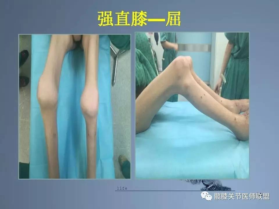 全膝关节置换术的手术流程和要点